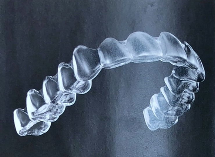 マウスピース型矯正装置(インビザライン)i GO システムによる前歯部の矯正治療