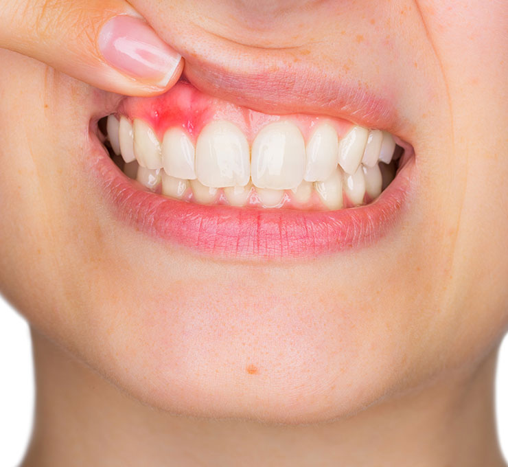 日高歯科クリニックの歯周病治療