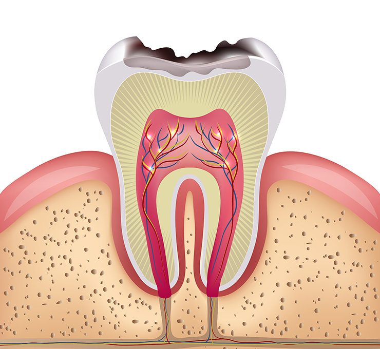 日高歯科クリニックの根管治療