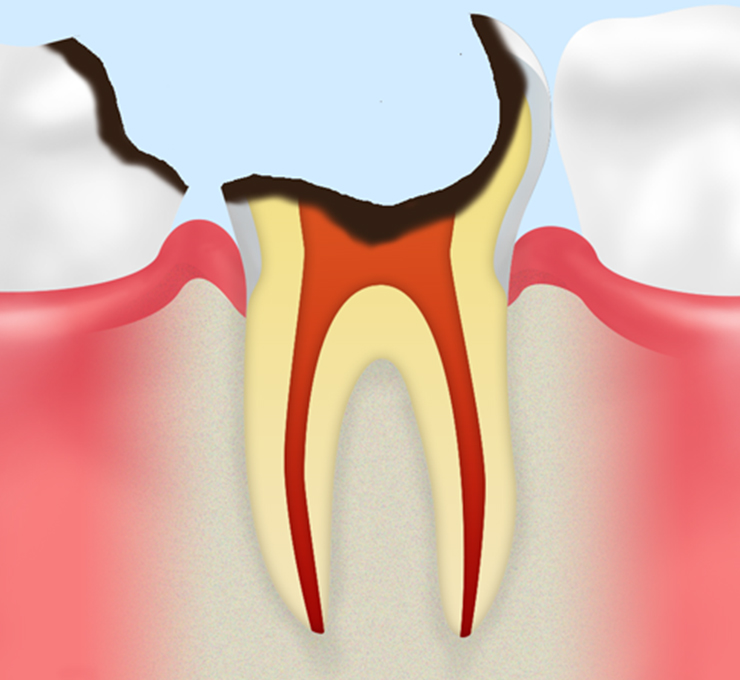 根管治療とは