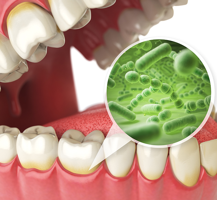 虫歯も歯周病も細菌による感染症です